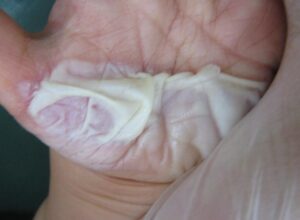 植皮を勧められた1歳児の手の熱傷(初診時の状態) - 粉瘤(アテローム) | こおりたひろ整形形成外科クリニック - 痛みの少ない粉瘤治療で多数の実績|大阪| 植皮が必要と診断された1歳児の手の熱傷(初診時)