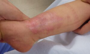 1歳児下腿の熱傷|湿潤療法で植皮せずに治癒(治療14日後) - 粉瘤(アテローム) | こおりたひろ整形形成外科クリニック - 痛みの少ない粉瘤治療で多数の実績|大阪| 植皮を勧められた1歳児の下腿の熱傷が、なつい式湿潤療法で治癒した状態(治療14日目)