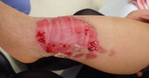 2つの大病院で植皮を勧められた1歳児の下腿の熱傷(初診時) - 粉瘤(アテローム) | こおりたひろ整形形成外科クリニック - 痛みの少ない粉瘤治療で多数の実績|大阪| 2つの大病院で植皮を勧められた1歳児の下腿の熱傷(初診時)