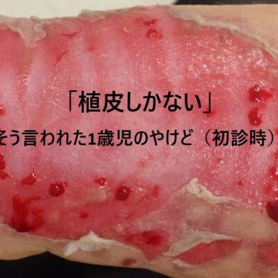 植皮を勧められた1歳児の下腿の熱傷の初診時写真｜なつい式湿潤療法による治療前の状態