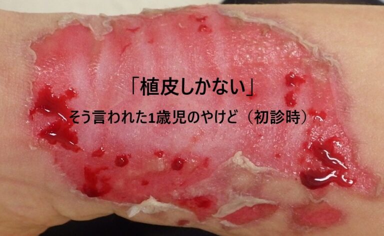 植皮を勧められた1歳児の下腿の熱傷の初診時写真｜なつい式湿潤療法による治療前の状態