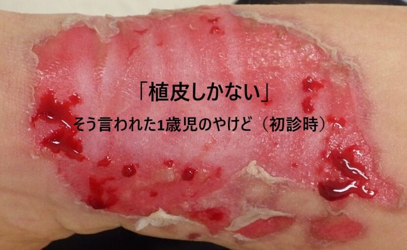植皮を勧められた1歳児の下腿の熱傷の初診時写真｜なつい式湿潤療法による治療前の状態
