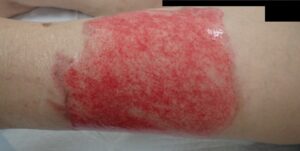 植皮を勧められた大腿の熱傷(初診時の状態) - 粉瘤(アテローム) | こおりたひろ整形形成外科クリニック - 痛みの少ない粉瘤治療で多数の実績|大阪| 植皮が必要と診断された大腿の熱傷(初診時)