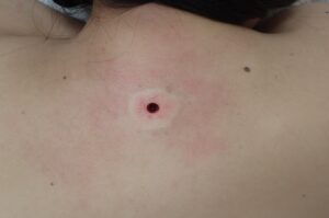 Postoperative Photo of Back Epidermoid Cyst Removal|Minimal Bleeding - 粉瘤(アテローム) | こおりたひろ整形形成外科クリニック - 痛みの少ない粉瘤治療で多数の実績|大阪| Immediately after punch excision of a back epidermoid cyst. Minimal bleeding observed.