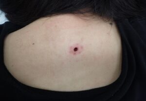 Back Atheroma Punch Excision Day 1|No Pain, Minimal Swelling - 粉瘤(アテローム) | こおりたひろ整形形成外科クリニック - 痛みの少ない粉瘤治療で多数の実績|大阪| Postoperative day 1 photo of a back atheroma after punch excision in a woman in her 40s. No pain and almost no swelling observed.
