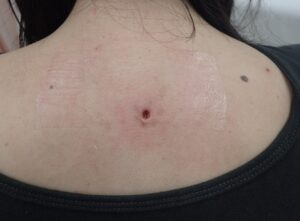 Back Atheroma Punch Excision Day 4|No Swelling, No Pain - 粉瘤(アテローム) | こおりたひろ整形形成外科クリニック - 痛みの少ない粉瘤治療で多数の実績|大阪| Postoperative day 4 photo of a back atheroma after punch excision in a woman in her 40s. No swelling, no pain, and no signs of infection.
