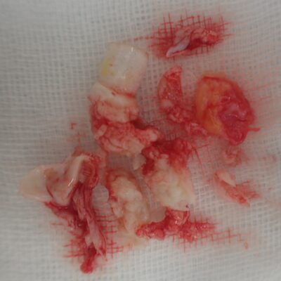 Excised specimen of a back atheroma after punch excision. Both the keratinous contents and the capsule were completely removed.