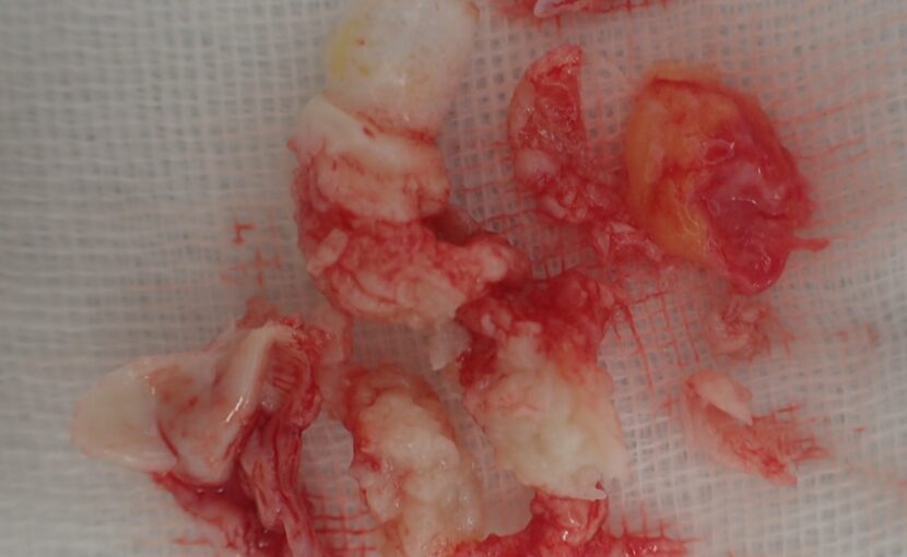 Excised specimen of a back atheroma after punch excision. Both the keratinous contents and the capsule were completely removed.