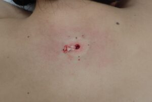 術中写真|背部の粉瘤(アテローム)の被膜をくりぬき法で摘出中 - 粉瘤(アテローム) | こおりたひろ整形形成外科クリニック - 痛みの少ない粉瘤治療で多数の実績|大阪| 40代女性の背部粉瘤(アテローム)を手術中に被膜を摘出している様子。くりぬき法を使用。