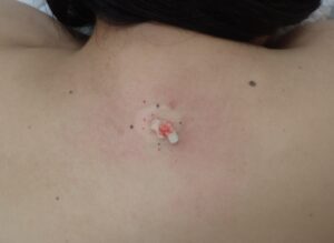 背部粉瘤(アテローム)術中写真|内容物を摘出している様子 - 粉瘤(アテローム) | こおりたひろ整形形成外科クリニック - 痛みの少ない粉瘤治療で多数の実績|大阪| くりぬき法で粉瘤(アテローム)の内容物を摘出している術中写真