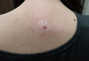 背部粉瘤(アテローム)くりぬき法 術後16日目|傷はほぼ治癒、痛みや腫れなし - 粉瘤(アテローム) | こおりたひろ整形形成外科クリニック - 痛みの少ない粉瘤治療で多数の実績|大阪| 背部粉瘤(アテローム)をくりぬき法で摘出した40代女性の術後16日目。痛みや腫れ、感染傾向はなく、傷はほとんど治癒している状態。
