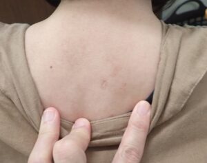 背部粉瘤(アテローム)くりぬき法 術後3年目|傷跡ほぼ消失、きれいに治癒 - 粉瘤(アテローム) | こおりたひろ整形形成外科クリニック - 痛みの少ない粉瘤治療で多数の実績|大阪| 背部粉瘤(アテローム)をくりぬき法で摘出した40代女性の術後3年目。傷跡はほとんど分からず、自然にきれいに治癒している状態。