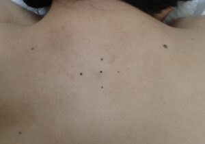 背部の粉瘤(アテローム)術前写真|6年間誤診された粉瘤 - 粉瘤(アテローム) | こおりたひろ整形形成外科クリニック - 痛みの少ない粉瘤治療で多数の実績|大阪| 背中にある6年間治らなかった粉瘤の術前写真。誤診され続けた粉瘤の状態。