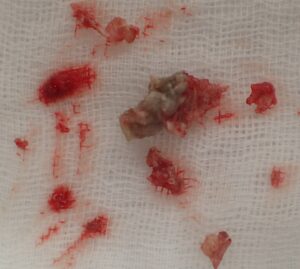 Excised specimen of an epidermoid cyst from the right cheek (female, 50s) removed via punch excision. The capsule and contents were completely extracted in one piece, preventing recurrence.