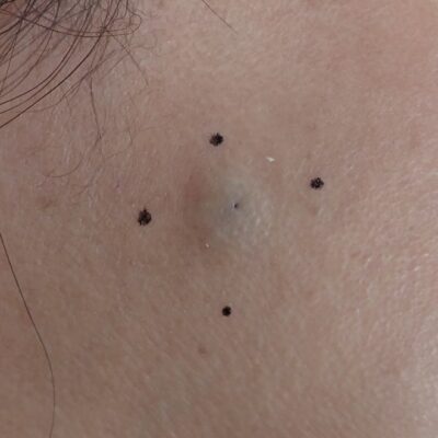 Preoperative photo showing an epidermoid cyst on the right cheek (female, 50s). A small subcutaneous lump is visible before punch excision and Natsui-style moist wound healing.