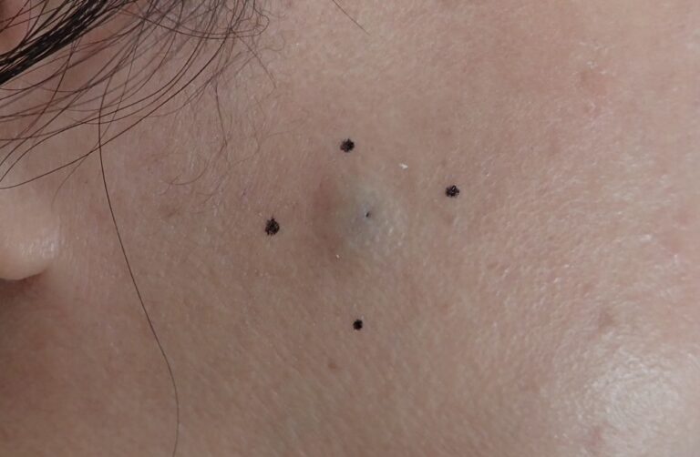 Preoperative photo showing an epidermoid cyst on the right cheek (female, 50s). A small subcutaneous lump is visible before punch excision and Natsui-style moist wound healing.