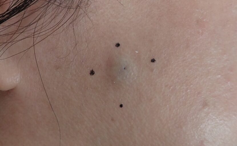 Preoperative photo showing an epidermoid cyst on the right cheek (female, 50s). A small subcutaneous lump is visible before punch excision and Natsui-style moist wound healing.