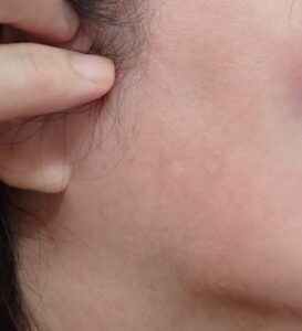 Six years after punch excision of an epidermoid cyst on the right cheek (female, 50s). The scar is barely visible, and the patient reports no discomfort. Managed with Natsui-style moist wound healing.