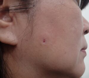 Postoperative day 11 photo after punch excision of an epidermoid cyst on the right cheek (female, 50s). No bleeding, pain, or swelling; the wound is almost fully healed with Natsui-style moist wound care.