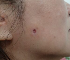 Postoperative day 4 photo after punch excision of an epidermoid cyst on the right cheek (female, 50s). No bleeding, pain, or swelling observed. The wound is epithelializing under Natsui-style moist wound care.