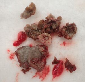 Specimen photo showing complete removal of the epidermoid cyst, including the capsule and contents, from the neck (male, 30s) using punch excision.