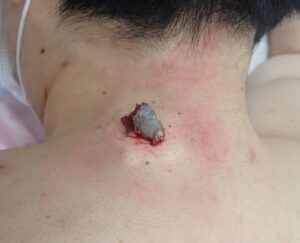 Intraoperative photo showing capsule (cyst wall) excision of a neck epidermoid cyst (male, 30s) using the punch excision technique.
