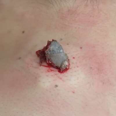 Intraoperative photo of a neck epidermoid cyst (male, 30s) showing capsule removal through a small punch opening using the Natsui-style method.