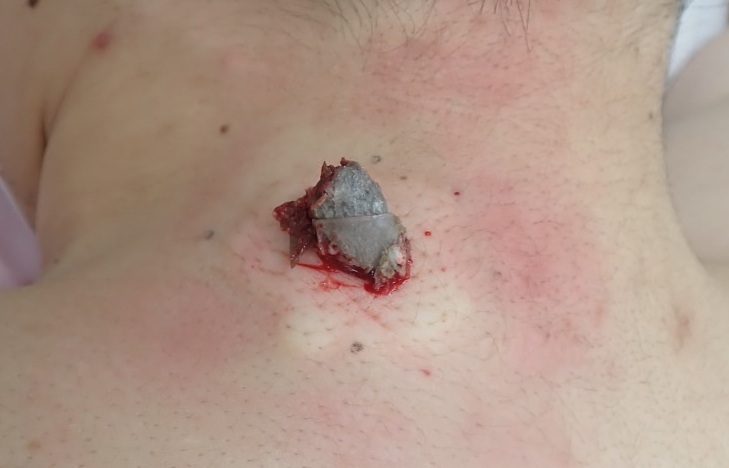 Intraoperative photo of a neck epidermoid cyst (male, 30s) showing capsule removal through a small punch opening using the Natsui-style method.