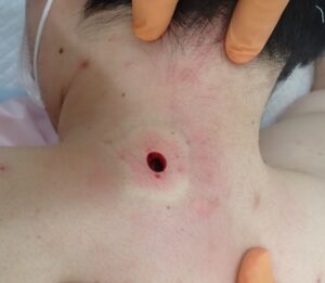 Immediate postoperative photo of a neck epidermoid cyst (male, 30s) showing minimal bleeding after complete capsule removal by punch excision.