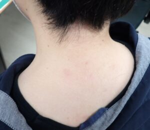 Photo taken 1.5 years after punch excision of a neck epidermoid cyst (male, 30s). The scar is barely visible and the patient is symptom-free.