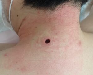 Postoperative day 1 photo of a neck epidermoid cyst (male, 30s). No bleeding or swelling is observed, and the patient reports no pain.