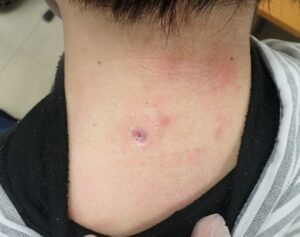 Postoperative day 14 photo of a neck epidermoid cyst (male, 30s). The wound is nearly healed with no redness, swelling, or infection.