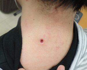 Postoperative day 9 photo of a neck epidermoid cyst (male, 30s). The wound is becoming shallower with no signs of infection or pain.