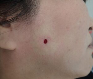 右頬の粉瘤（アテローム）をくりぬき法で摘出した直後の写真。ほとんど出血は認められない。術後はなつい式湿潤療法で管理し、痛みも最小限。