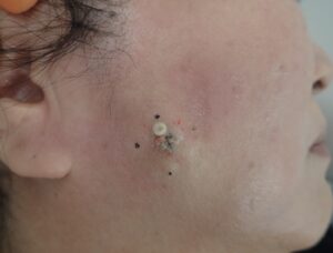右頬の粉瘤（アテローム）をくりぬき法で摘出している術中写真。被膜と内容物を排出している様子。手術は局所麻酔下で行い、なつい式湿潤療法で創部を管理。
