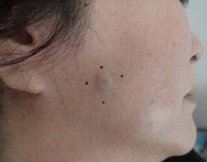 右頬にできた粉瘤（アテローム）の術前写真。50代女性。地元の形成外科で「顔の手術は傷跡が残るからしない方が良い」と言われたが、当院でくりぬき法＋なつい式湿潤療法による治療を予定。