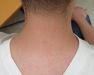 粉瘤(頚部・炎症性)術後8年|くりぬき法で再発なく傷跡目立たず【大阪】 - 粉瘤(アテローム) | こおりたひろ整形形成外科クリニック - 痛みの少ない粉瘤治療で多数の実績|大阪| 頚部の炎症性粉瘤をくりぬき法で摘出後、なつい式湿潤療法で治療した患者の術後8年経過写真。再発もなく、傷跡はほとんど分からない。