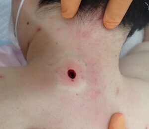 30代男性の頚部粉瘤（アテローム）術直後の写真。くりぬき法で被膜ごと摘出後、出血はほとんど認められません。