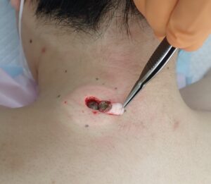 30代男性の頚部粉瘤（アテローム）術中写真。くりぬき法でパンチを用いて皮膚に穴を開けた直後の様子。