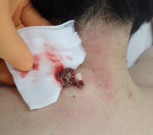 30代男性の頚部粉瘤（アテローム）術中写真。くりぬき法で皮膚の孔から内容物を排出している様子。