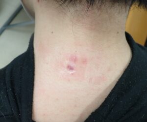 30代男性の頚部粉瘤（アテローム）術後21日目の写真。創は完全に治癒し、感染や痛みは認められません。