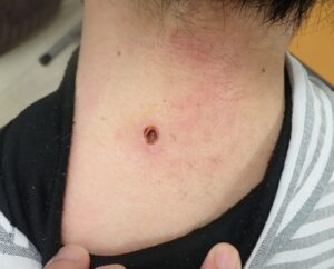 30代男性の頚部粉瘤（アテローム）術後4日目の写真。感染傾向はなく、患者さんは痛みも全くないと話されています。