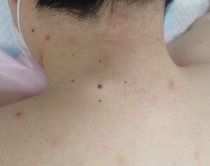 30代男性の頚部にできた粉瘤（アテローム）の術前写真。被膜を含むしこりが皮下に見られる。