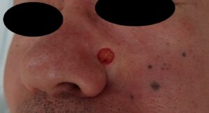 ほくろ切除(顔・50代男性)|術直後の写真 - 粉瘤(アテローム) | こおりたひろ整形形成外科クリニック - 痛みの少ない粉瘤治療で多数の実績|大阪| 顔のほくろ切除術直後の写真。局所麻酔下で丁寧に切除を行い、術後はなつい式湿潤療法で管理。