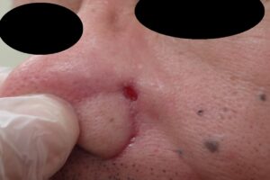 ほくろ切除(顔・50代男性)|術後15日目の経過 - 粉瘤(アテローム) | こおりたひろ整形形成外科クリニック - 痛みの少ない粉瘤治療で多数の実績|大阪| 顔の黒子くりぬき法術後15日目の写真。出血・感染・痛みなし。創部は平坦化し順調に治癒。