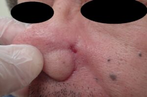 ほくろ切除(顔・50代男性)|術後22日目の経過 - 粉瘤(アテローム) | こおりたひろ整形形成外科クリニック - 痛みの少ない粉瘤治療で多数の実績|大阪| 顔の黒子くりぬき法術後22日目の写真。出血・感染・痛みなし。傷はほぼ治癒。
