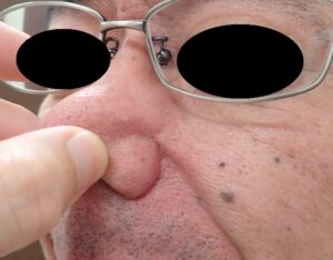 ほくろ切除(顔・50代男性)|術後8年の経過 - 粉瘤(アテローム) | こおりたひろ整形形成外科クリニック - 痛みの少ない粉瘤治療で多数の実績|大阪| 顔の黒子くりぬき法術後8年の写真。傷跡ほとんどなし。自然にきれいに治癒。
