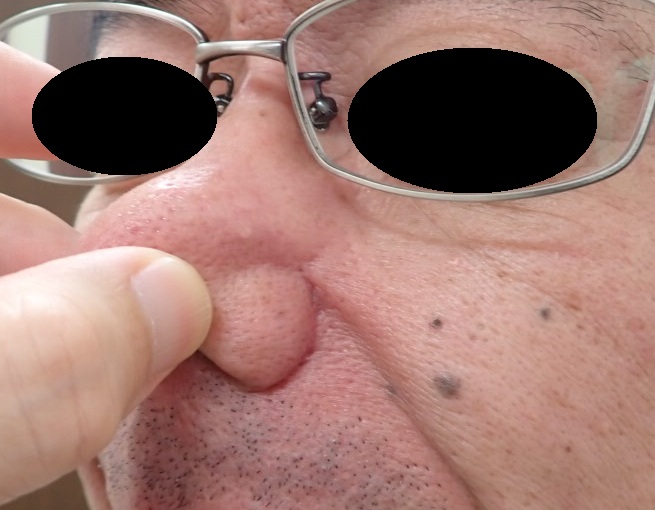 顔の黒子くりぬき法術後8年の写真。傷跡ほとんどなし。自然にきれいに治癒。
