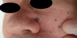 ほくろ切除(顔・50代男性)|術前写真と湿潤療法 - 粉瘤(アテローム) | こおりたひろ整形形成外科クリニック - 痛みの少ない粉瘤治療で多数の実績|大阪| 顔のほくろ切除術前写真。10年以上前からある黒子が大きくなり、切除を希望された50代男性。