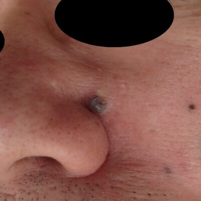 顔のほくろ切除術前写真。10年以上前からある黒子が大きくなり、切除を希望された50代男性。